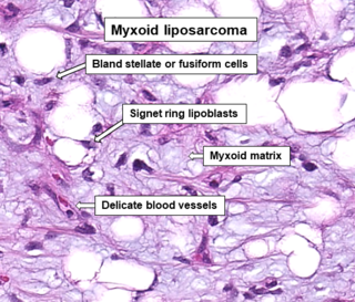 <span class="mw-page-title-main">Myxoid liposarcoma</span> Medical condition