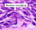 Thumbnail for File:Histopathology of small cell carcinoma - nuclear smudging.png
