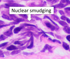 Histopathology of small cell carcinoma - nuclear smudging.png