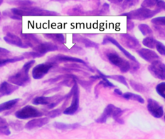 Small cell carcinoma is a cancer where the presence of smudging is a clue to the diagnosis.[6]