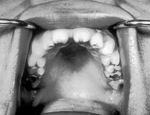 Hutchinson teeth congenital syphilis PHIL 2385.rsh.jpg