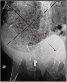 Journal.pmed.1000092.g002 fecal impaction