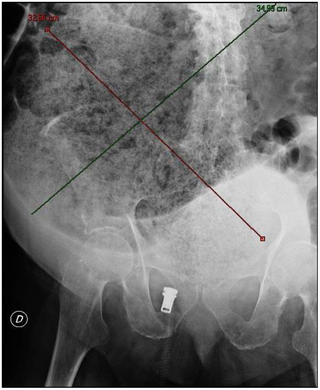 Impactación fecal - Wikipedia, la enciclopedia libre