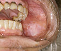 Thumbnail for Leukoplakia