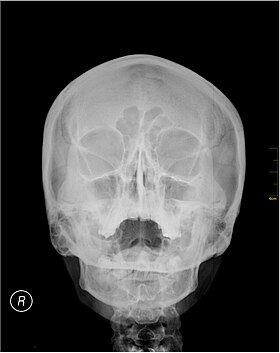 Medical X-Ray imaging PZJ06 nevit.jpg