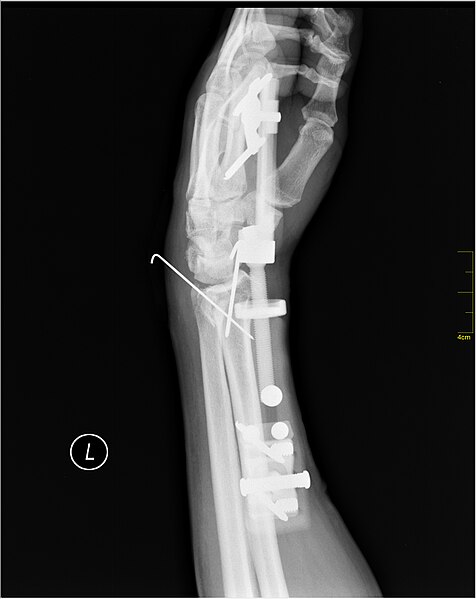 File:Medical X-Ray imaging TKX07 nevit.jpg