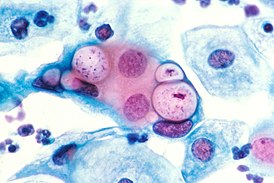 Pap smear showing clamydia in the vacuoles 500x H&E.jpg