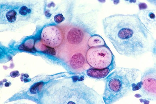 Хламидия trachomatis. Хламидия пситаци. Chlamydia trachomatis под микроскопом.