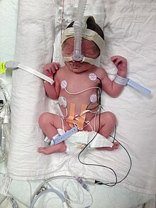 Preterm birth at 32 weeks 4 days, with a weight of 2,000 g attached to medical equipment Premature birth Alberta, Canada.jpg