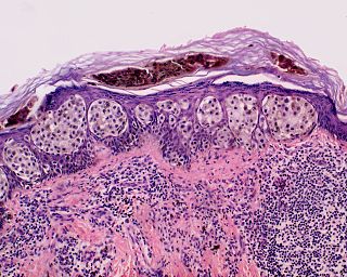 Superficial spreading melanoma