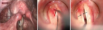 Vocal Fold Cyst and mucosal bridge after dissection Vocal Fold Cyst after dissection.jpg