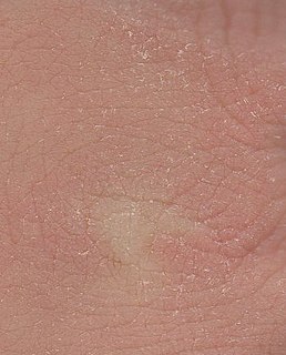 Xeroderma A condition characterised by dry skin