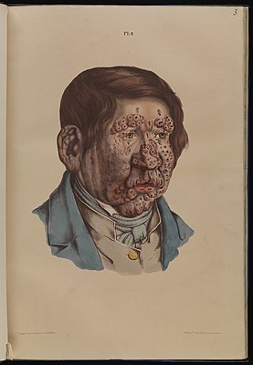 A 13-year-old boy with severe leprosy