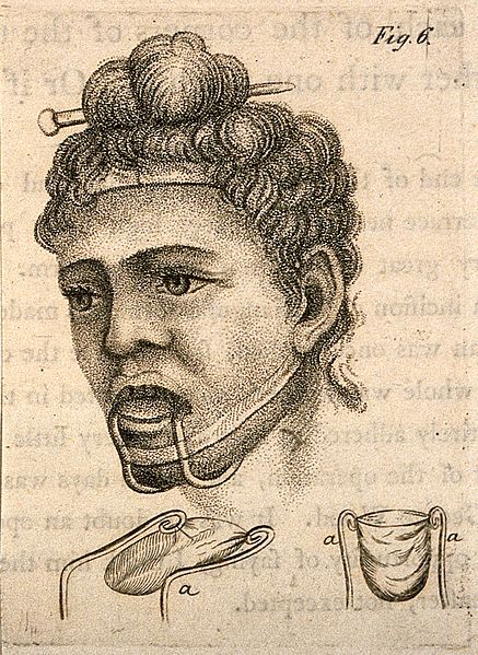 File:A diagram of a head illustrating a jaw and chin brace. Stipp Wellcome V0016851ER.jpg