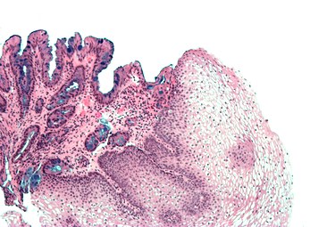 Micrografía del epitelio escamoso estratificado normal y el epitelio metaplásico del esófago de Barrett (izquierda de la imagen). Tinción azul alcián.