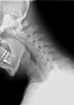 Cervical Xray Extension view