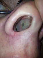 Nasal septum perforation caused from cocaine abuse. Cocaine nose.jpg