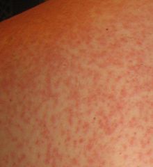Maculopapular Rash, note: this image shows a nonspecific rash that is not necessarily associated with an acute HIV infection Cross Reaction Rash cropped.jpg