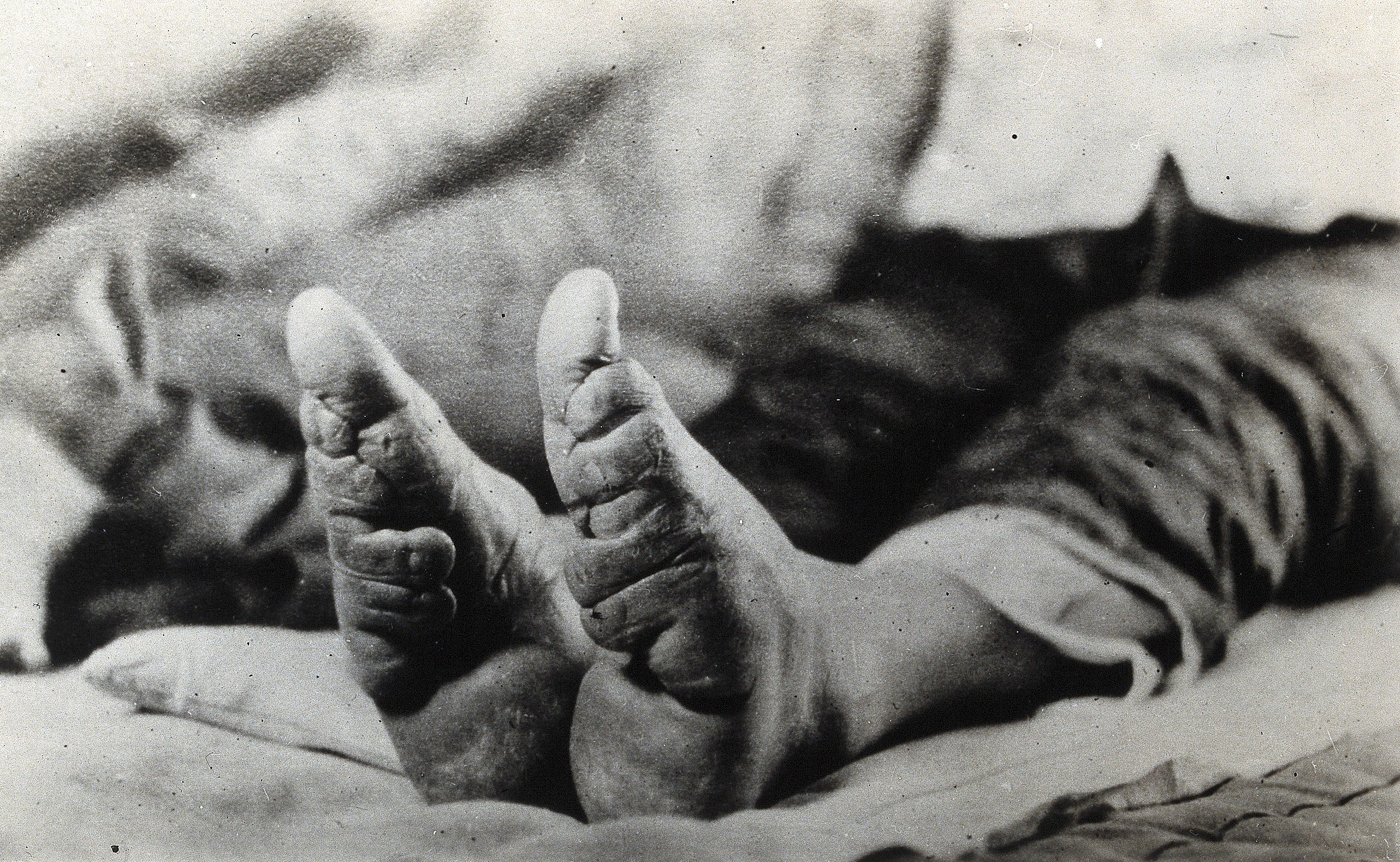 File:Feet of a Chinese woman, showing the effect of foot-binding