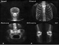 Vier planare Aufnahmen des Skelettes eines Patienten. (Im Uhrzeigersinn von oben links: Kopf, Brust, Knie, Becken).