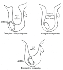 Different types of inguinal hernias.