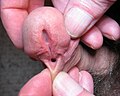 Example of penis with hypospadias