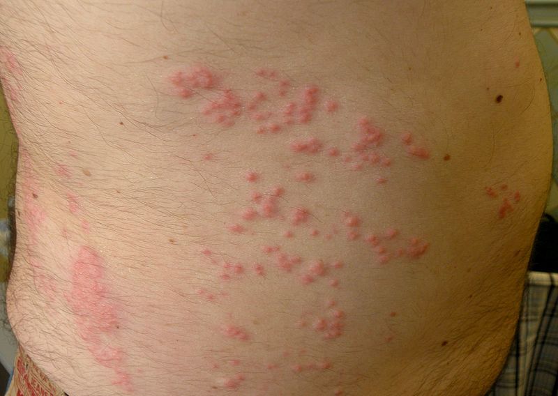 File:Jellyfish dermatitis case1 abdominal skin lateral.jpg