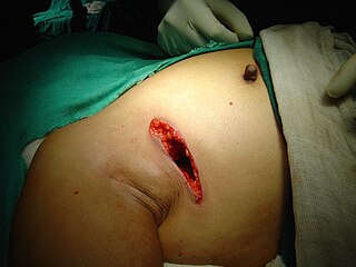 <span class="mw-page-title-main">Lumpectomy</span> Limited surgical removal of breast tissue