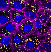 Nano particles injected into a tumor to use photothermal therapy Nanoparticles (yellow) targeting and entering cancer cells (blue).png