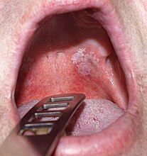 Leukoplakia of the soft palate