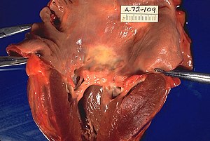 Rheumatic heart disease, gross pathology 20G0013 lores.jpg