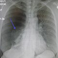 pneumothorax ขนาดใหญ่ที่เกิดขึ้นเองที่ปอดข้างขวา (ในรูปด้านซ้าย) ส่วนลูกศรแสดงปอดที่ยุบตัวลง ให้สังเกตว่าเยื่อหุ้มปอดที่แสดงในภาพเอ็กซเรย์มีสีขาว