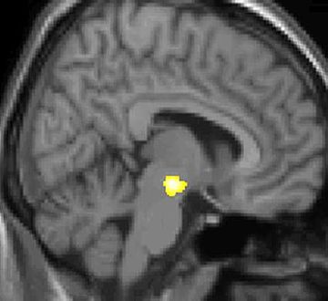 Example of a VBM analysis on patients who experience cluster headaches. VBM1.jpg