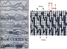 Catecholaminergic Polymorphic Ventricular Tachycardia Wikipedia