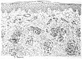 Figure 42. Lupus vulgaris simplex. The corium is studded with little collections of tuberculous follicles which make up the apple-jelly nodules. The vessles are dilated and the tissues between the nodules contain many leuocytes. Teh epithelium is slightly cedematous and the horny layer is irrefular. 75x