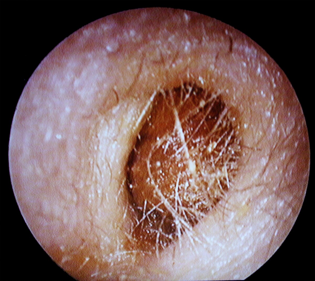 Le plus gros cérumen retiré d'une oreille