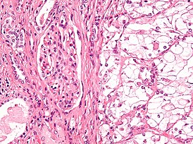 Микрофотография, демонстрирующая наиболее частый тип рака почки — светлоклеточный (окраска гематоксилином и эозином)