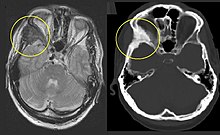 Fibrous dysplasia of the right zygomatic bone (left). Corresponding T2-weighted MRI (left) and CT (right) of the same patient. Dysplasia fibrosa.jpg