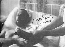 Czarno-białe archiwalne zdjęcie mężczyzny w szpitalnym łóżku podnoszącego rękę do amputowanej dłoni.