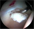 Figure 8. Cartilage delamination. A small area of acetabular cartilage has lifted from the underlying bone, being demonstrated by use of the arthroscopic probe..png