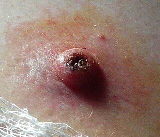 Keratoacanthoma Human disease