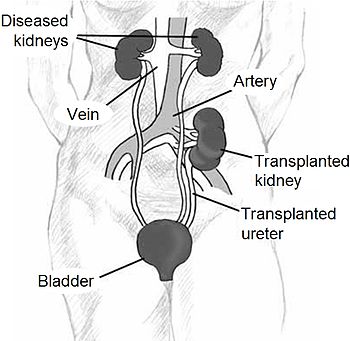 Kidney location after transplantation. Adapted...