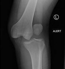 knee dislocation x ray