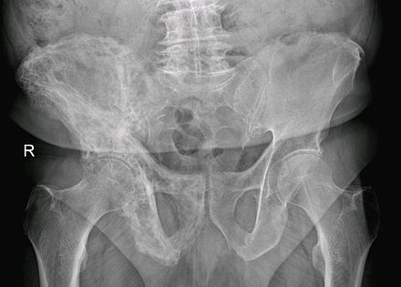 Paget's disease of right pelvic bone