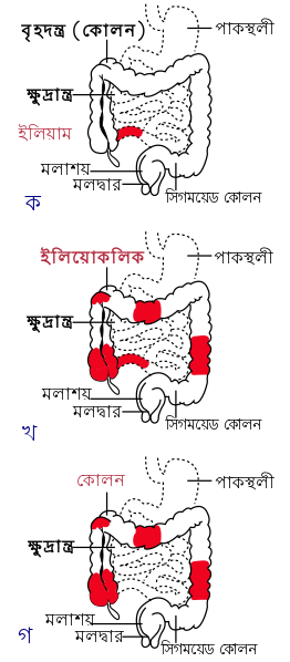 File:Patterns of Crohn's Disease-bn.svg