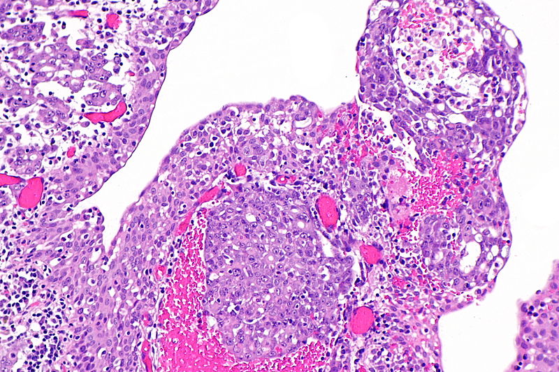 File:Renal medullary carcinoma - 2 -- intermed mag.jpg