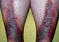 Stasis dermatitis (Gravitational eczema).jpg