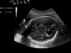Ultrasound Scan ND 1231102308 1028500.png