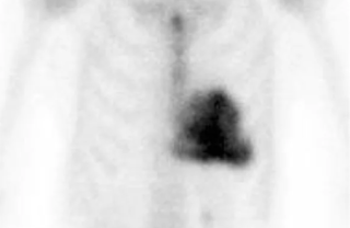 <span class="mw-page-title-main">DPD scan</span> Nuclear medicine scan