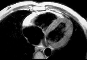 MRI in a patient affected by ARVC/D (long axis view of the right ventricle): note the transmural diffuse bright signal in the RV free wall on spin echo T1 (a) due to massive myocardial atrophy with fatty replacement (b).